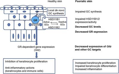 Glucocorticoids and Glucocorticoid-Induced-Leucine-Zipper (GILZ) in Psoriasis